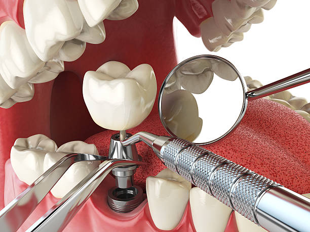Best Lost Filling or Crown Replacement in Prairie Heights, WA